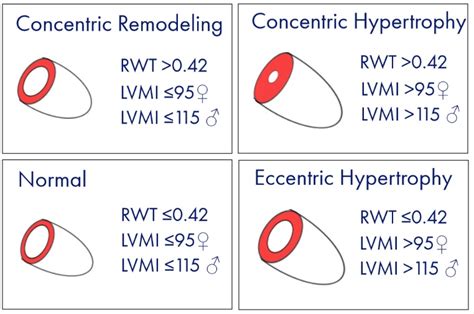 lvmi